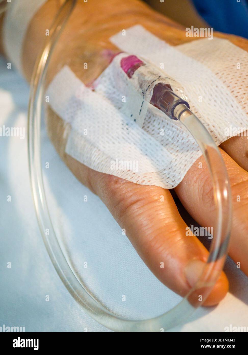 Platzierung einer intravenösen Durchstechflasche (periphere Venenkatheterisierung), Son Llatzer Hospital, Mallorca, Balearen, Spanien. Stockfoto