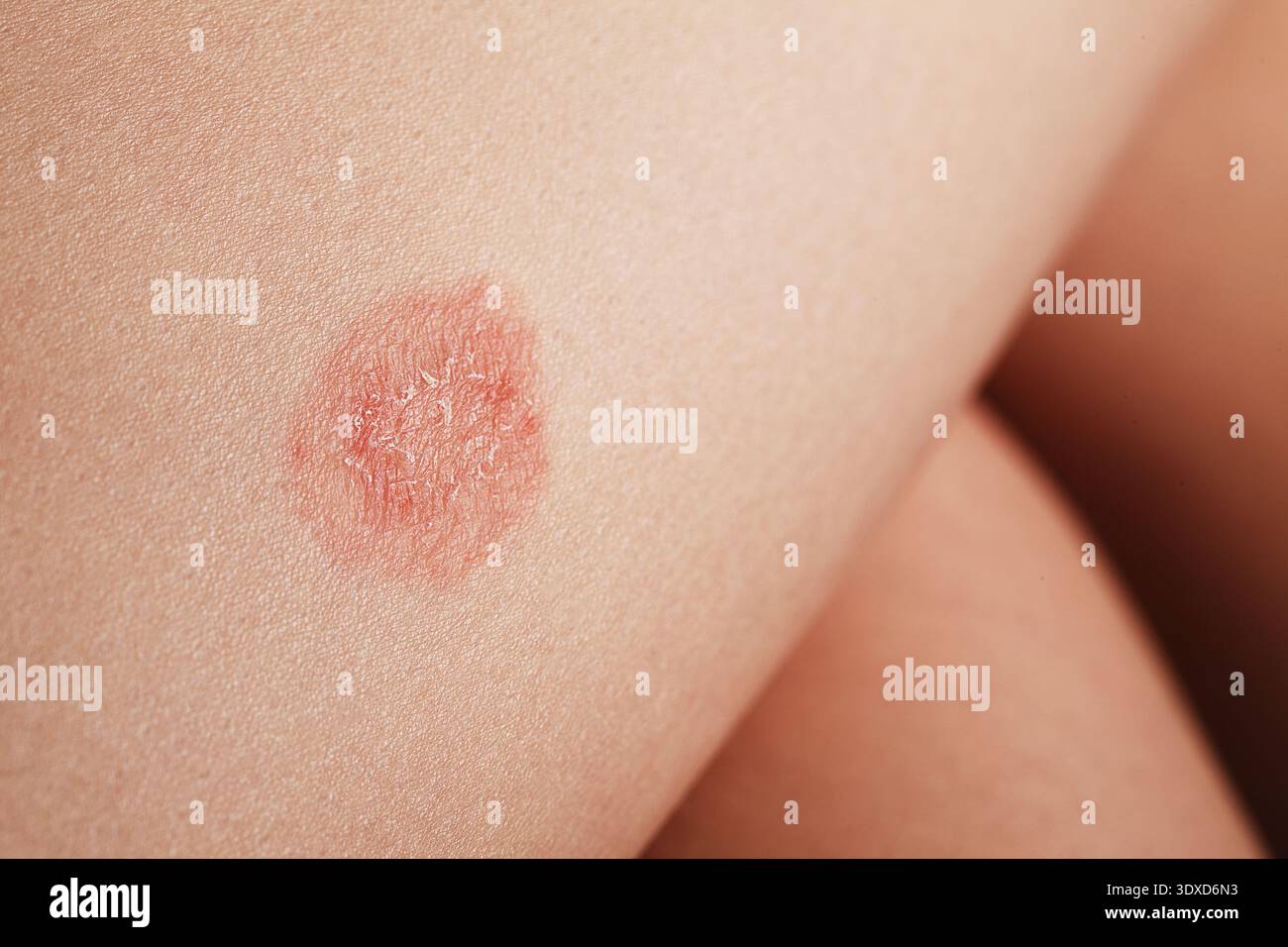 Detailliertes Hautproblem. Rosea, Hochauflösendes Bild, Das Unregelmäßigkeiten Und Hautausschläge Deutlich Hervorhebt. Nahaufnahme Mit Detaillierten Hautläsionen Stockfoto