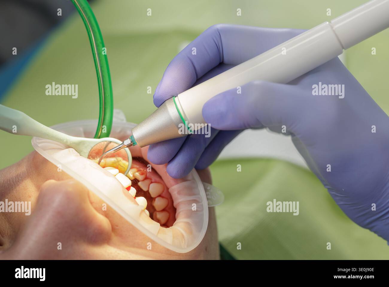 Zahnarztaufnahmemöglichkeiten mit Ultraschall-Scaler und -Spiegel während der professionellen Zahnreinigung in der modernen Zahnklinik. Prophylaktisches Vorgehen im Mundbereich Stockfoto