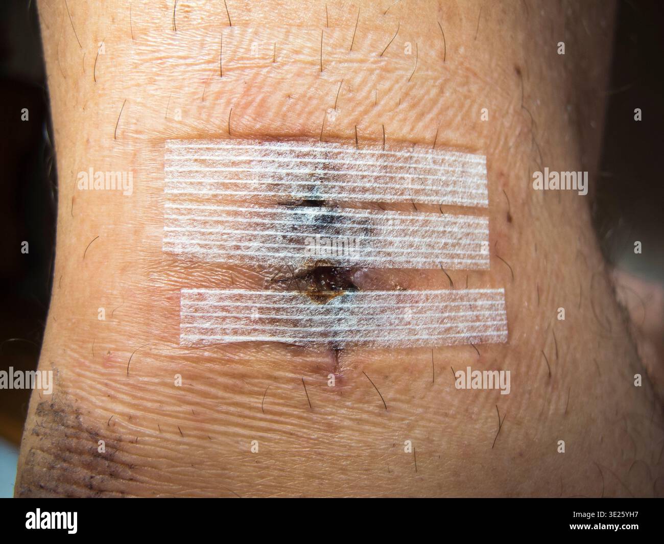 Nahaufnahme einer kleinen heilenden Operationsnarbe nach Nahtentfernung, stabilisiert mit drei Klebestreifen an einem männlichen Unterschenkel. Stockfoto