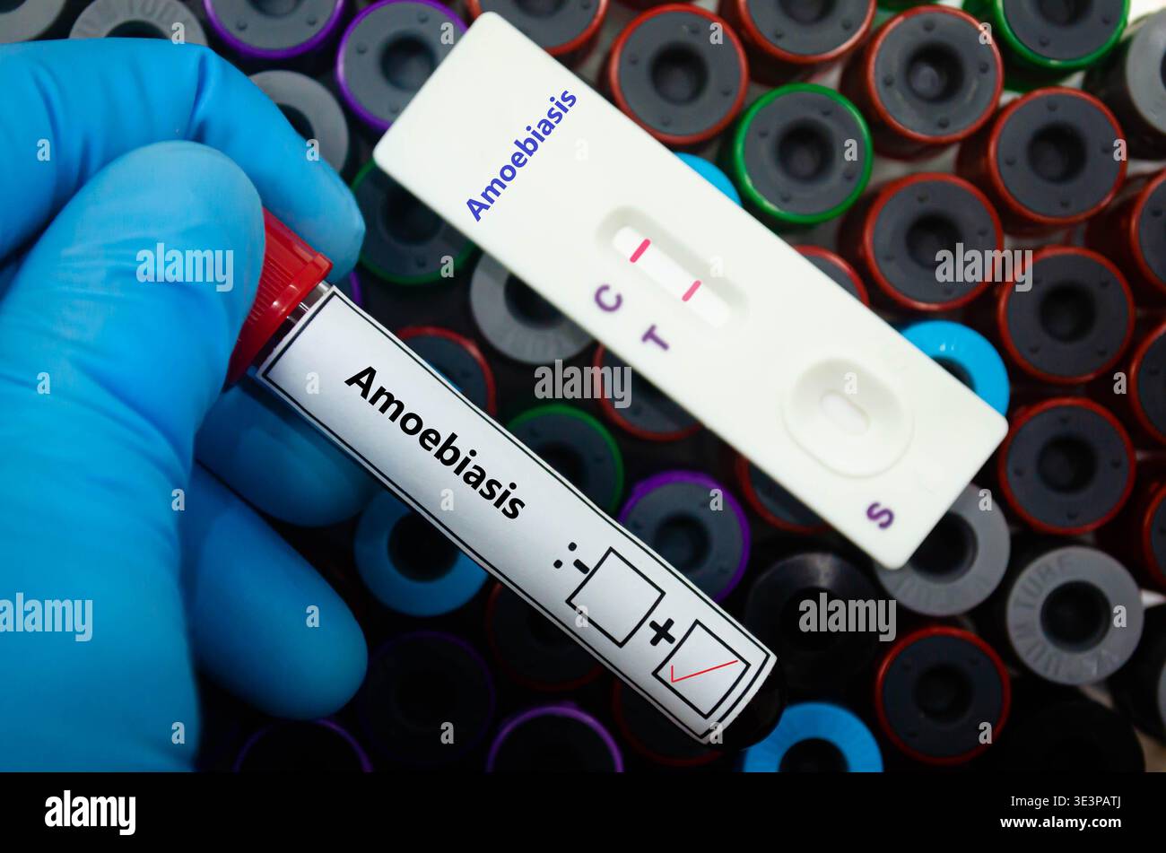 Blutprobe eines Patienten-positiven Ergebnisses bei Amöbiasis. Stockfoto
