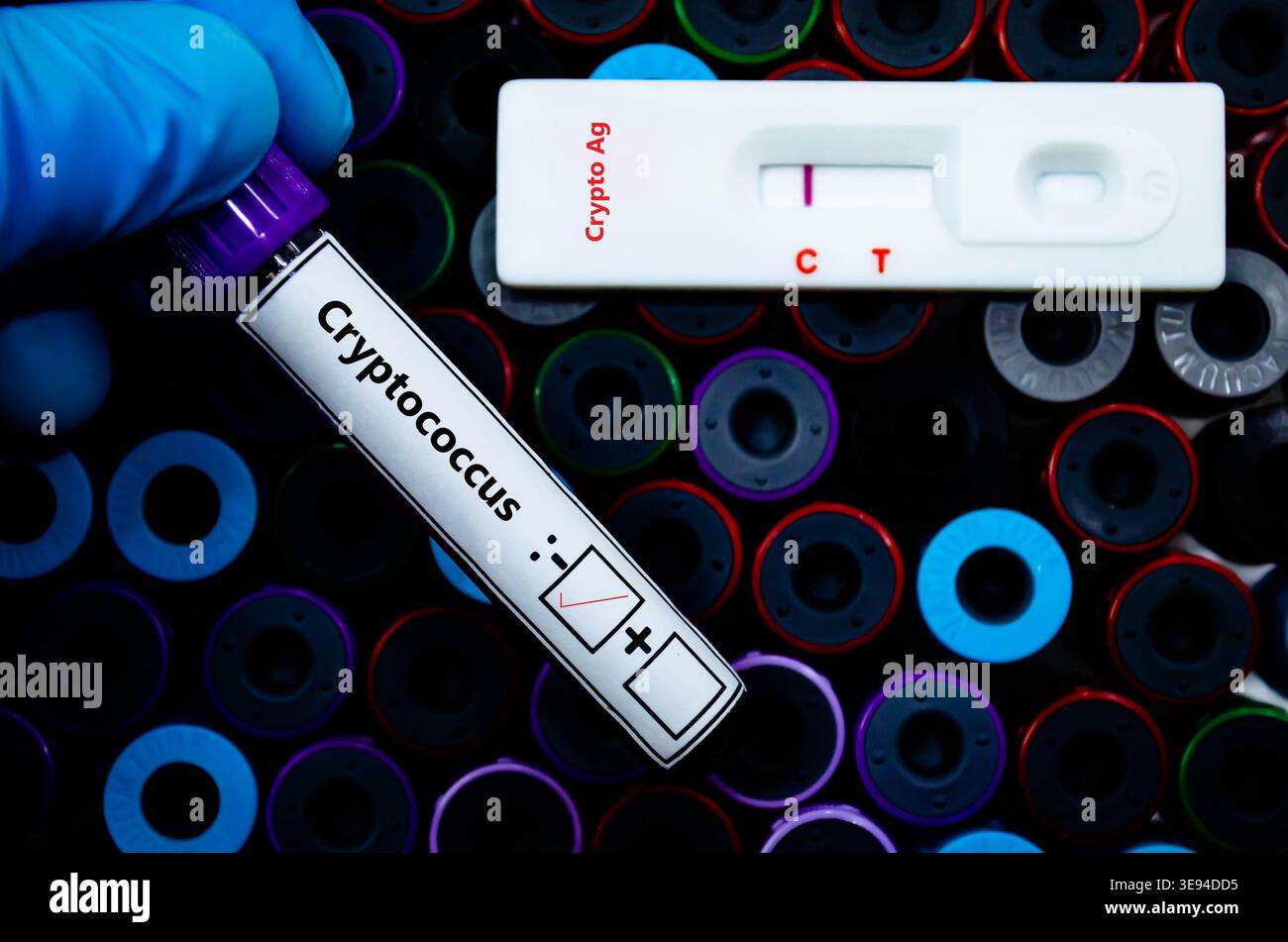 Blutprobe eines Patienten-negativen Ergebnisses für Cryptococcus AG. Stockfoto