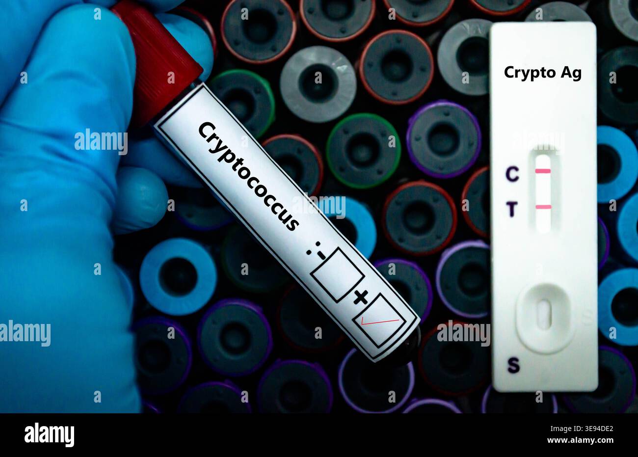 Blutprobe eines Patienten-positiven Ergebnisses für Cryptococcus AG. Stockfoto