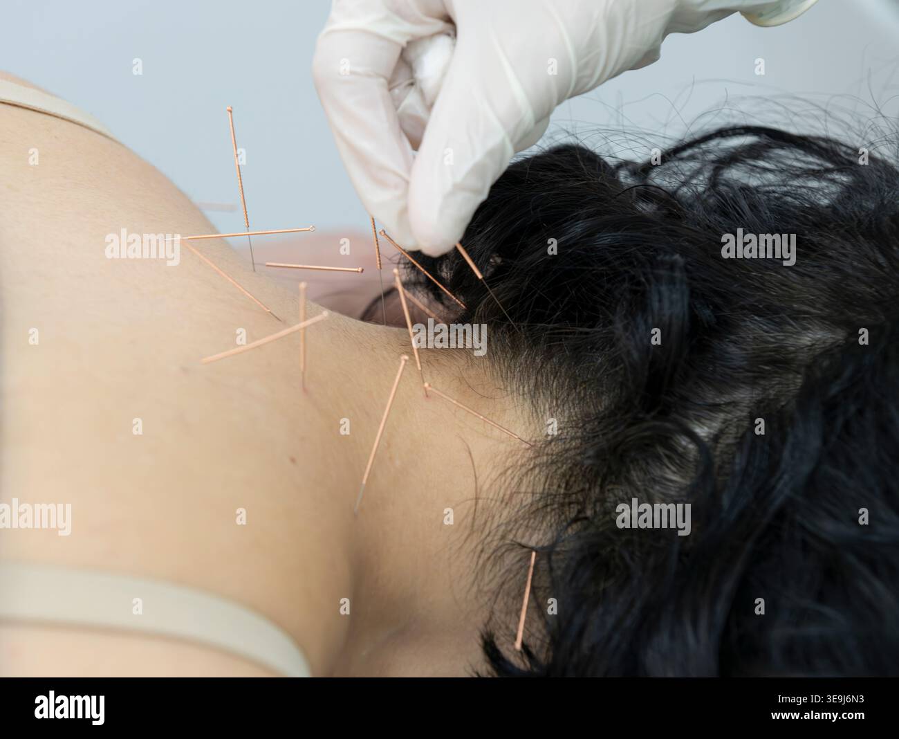 Arzt mit Handschuhen entfernt mehrere Akupunkturnadeln aus dem Hals- und Schulterbereich der weiblichen Patientin nach der Behandlung. Stockfoto