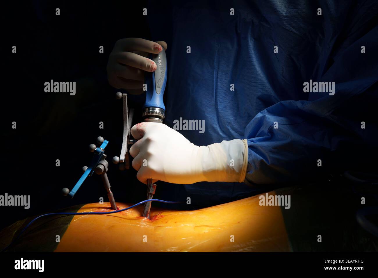 Chirurg, der eine präzise Wirbelsäulenchirurgie mit Navigations-Tracking-Instrumenten im Operationssaal durchführt Stockfoto
