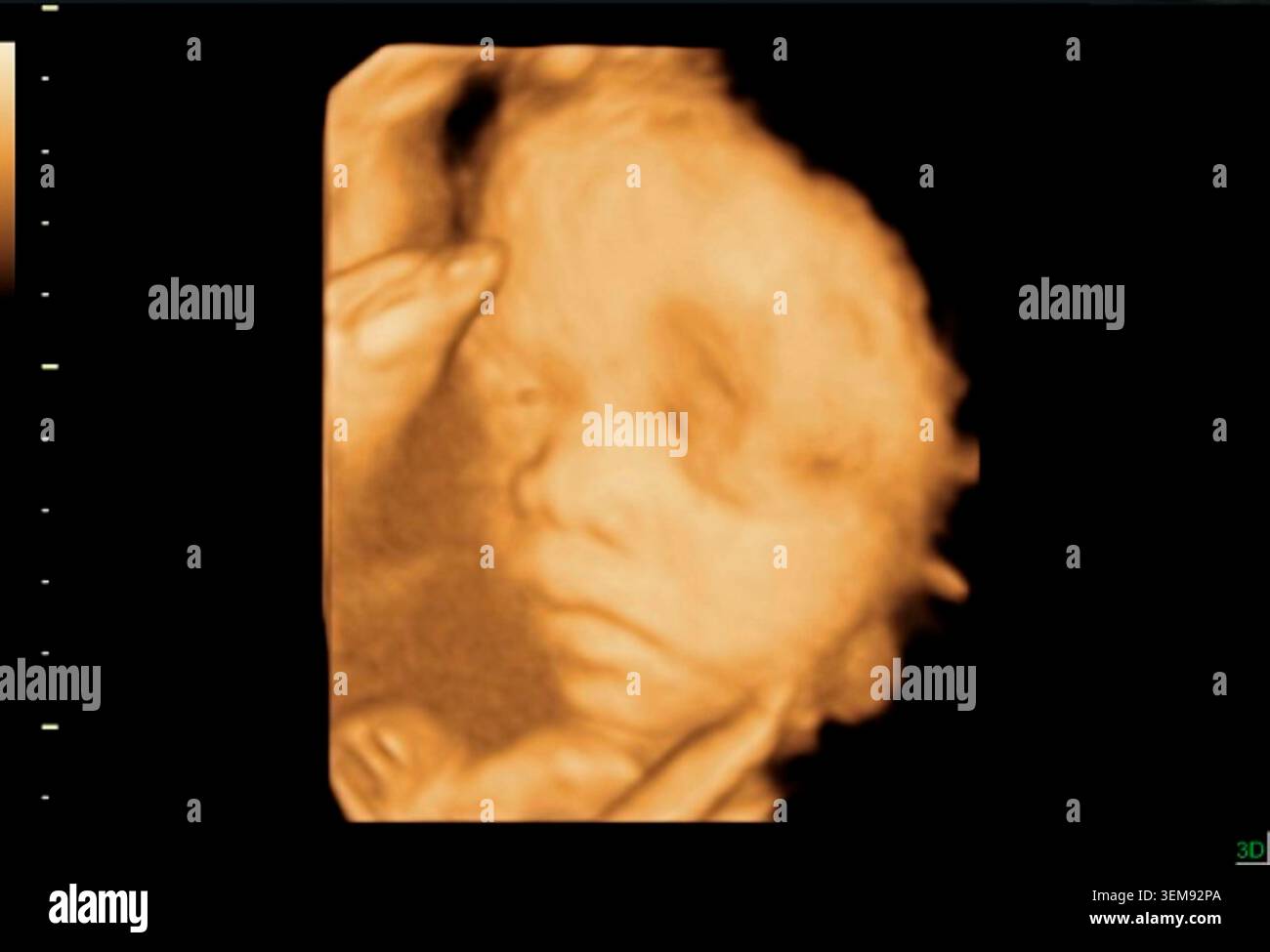 3D-Sonographie des Kopfes eines Fetus nach 28 Wochen. In diesem Stadium gewinnt das Baby schnell an Gewicht, entwickelt einen stärkeren Muskeltonus und verfeinert lebenswichtige Funktionen zur Vorbereitung auf die Geburt. Stockfoto