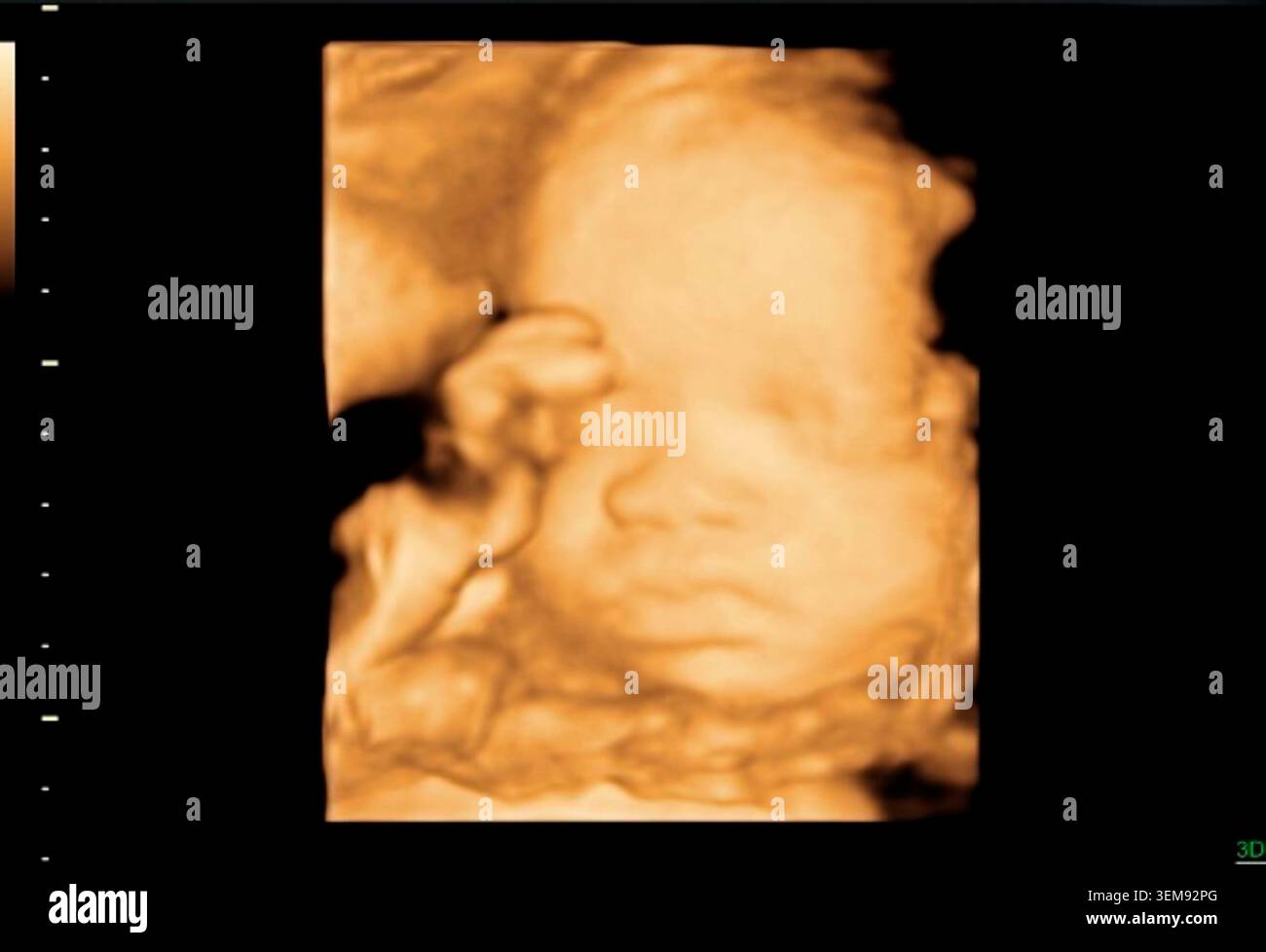 3D-Sonographie des Kopfes eines Fetus nach 28 Wochen. In diesem Stadium gewinnt das Baby schnell an Gewicht, entwickelt einen stärkeren Muskeltonus und verfeinert lebenswichtige Funktionen zur Vorbereitung auf die Geburt. Stockfoto