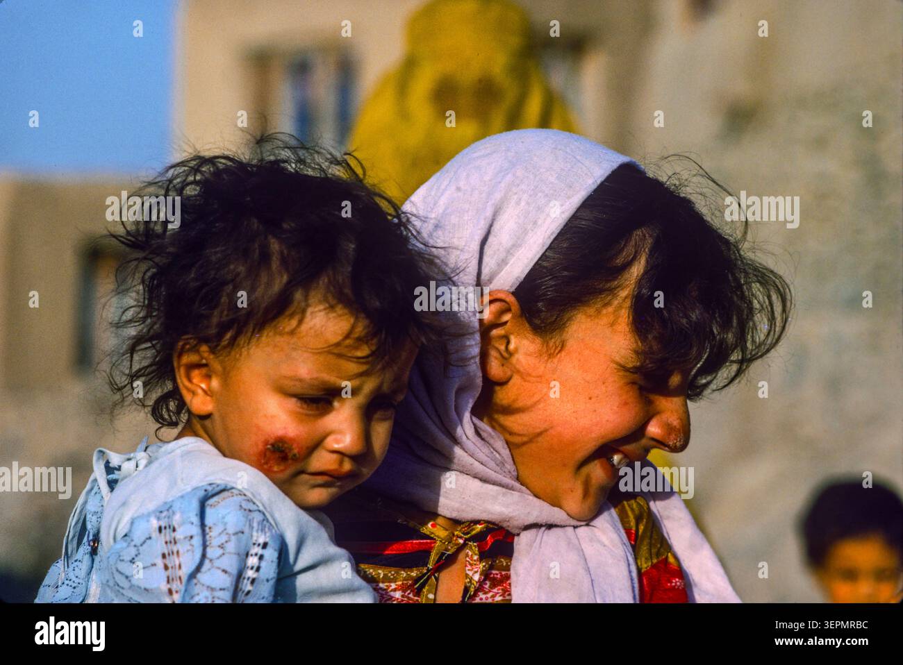 Kinder in Hügellagerung in Kabul. Hautkrankheiten sind in der Region häufig, vielleicht aufgrund von Armut und schlechten sanitären Einrichtungen, Afghanistan, August 1992 Stockfoto