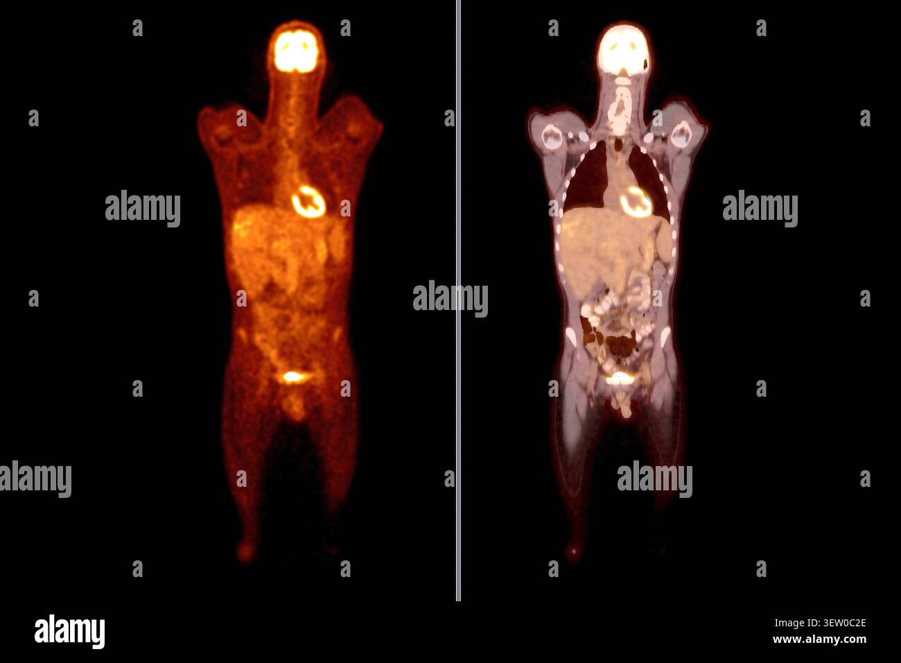 PET-CT oder Kernscan eines Patienten mit normalem Ganzkörperskelett. Fortgeschrittene Diagnostik in der Nuklearmedizin und molekularen Bildgebung. Stockfoto