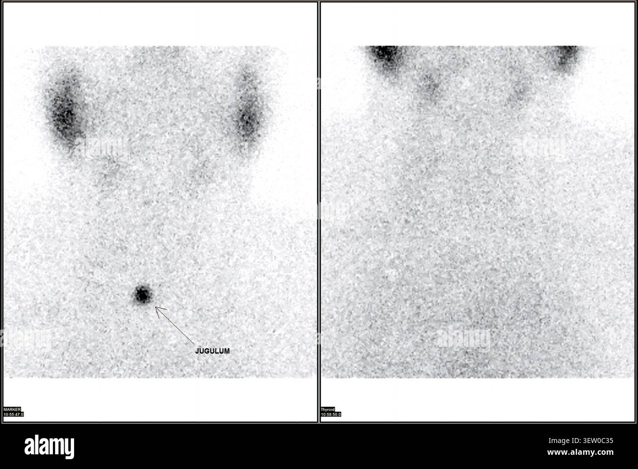 PET-CT oder Kernscan eines Patienten mit normalem Ganzkörperskelett. Fortgeschrittene Diagnostik in der Nuklearmedizin und molekularen Bildgebung. Stockfoto