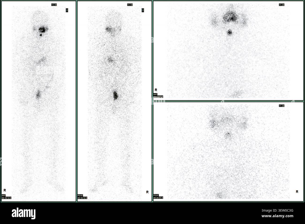 PET-CT oder Kernscan eines Patienten mit normalem Ganzkörperskelett. Fortgeschrittene Diagnostik in der Nuklearmedizin und molekularen Bildgebung. Stockfoto