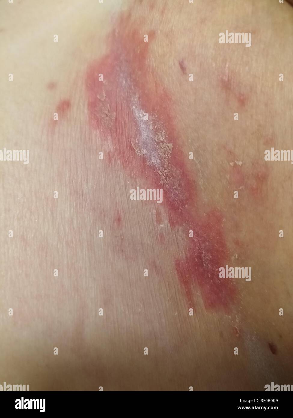 Nahaufnahme von rotem Hautausschlag mit trockenen Schuppen und Reizung an der menschlichen Haut, der Symptome einer allergischen Reaktion, Dermatitis oder Ekzeme zeigt, für medizinische Zwecke - Smartphone-aufgenommenes Stockfoto