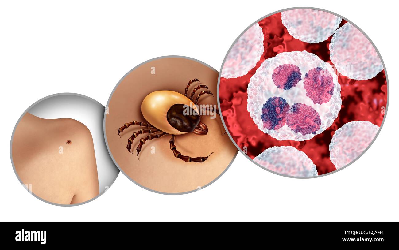 Anaplasmose und schwarzbeinige Zecke, die auf der Haut kriecht, als bakterielle Infektionsgefahr, die durch Anaplasma phagocytophilum übertragen wird, durch die Stockfoto
