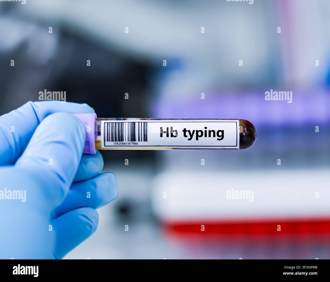 Blutprobenröhrchen für die Hb-Typisierungstestanalyse. Stockfoto