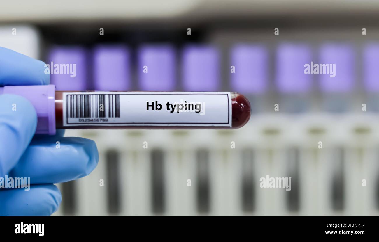 Blutprobenröhrchen für die Hb-Typisierungstestanalyse. Stockfoto