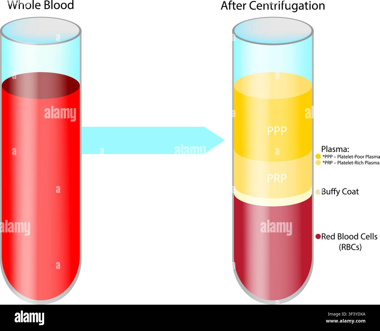 Medizinische Vektorillustration, die den PRP-Plasma-reichen-Plasma-Vorbereitungsprozess nach der Blutzentrifugation zeigt. Diagramm plasmaarmes Plasma PPP Stock Vektor