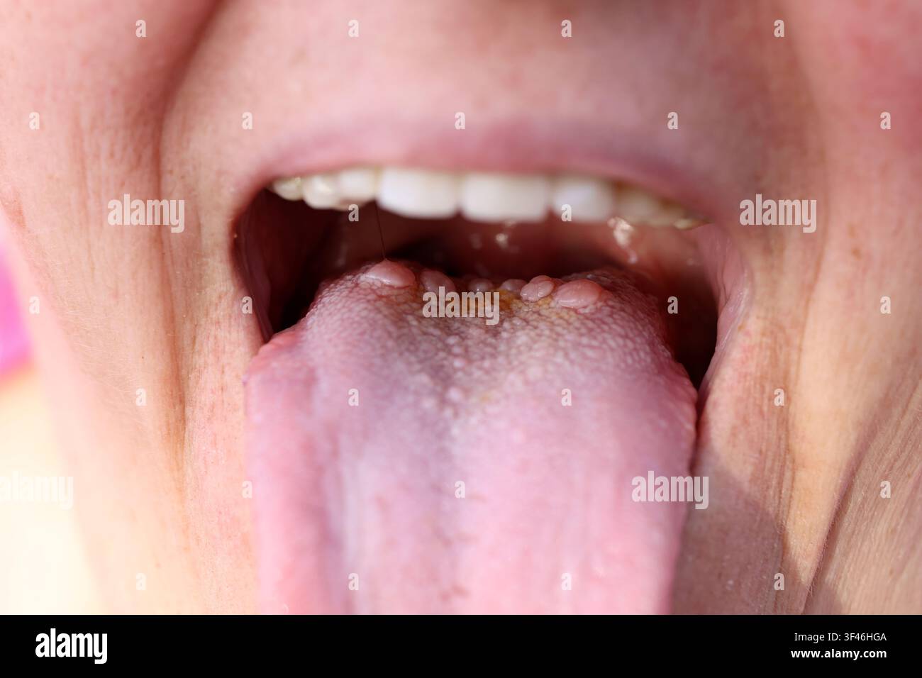Menschliche Zunge, die Wallpapillen und Geschmacksknospen zeigt Stockfoto