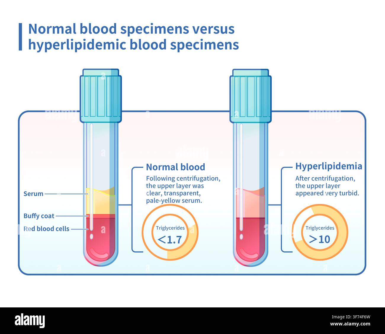 Illustration, die die makroskopische Morphologie von normalen Blutproben und Hyperlipidämie-Proben nach der Zentrifugation vergleicht. Die linke normale Probe zeigt eine klare Schichtung mit einer transparenten, blassgelben Serumschicht an der Oberseite. Die rechte Hyperlipidämie-Probe zeigt nach der Zentrifugation ein deutlich trübes oder chylöses Aussehen in der oberen Serumschicht, was den Einfluss abnormal erhöhter Triglyceridspiegel auf die physikalischen Eigenschaften des Blutes visuell widerspiegelt. Stockfoto