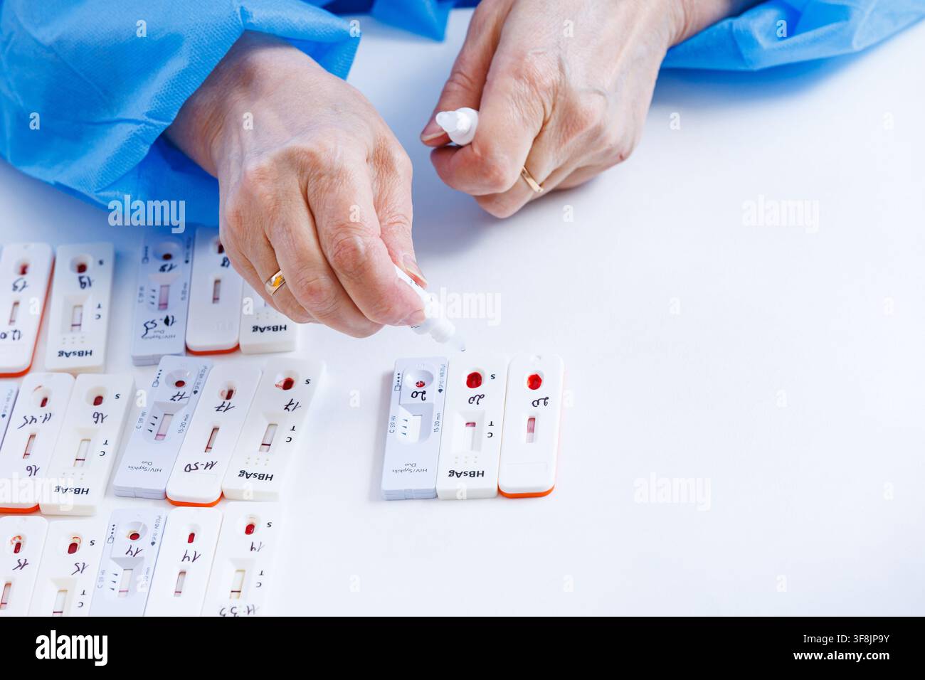 Ein Gesundheitsfachkraft in einem blauen Kittel gibt Pufferreagentientropfen auf Schnelltestkassetten mit Blutproben für HIV- und Hepatitis-Diagnose Stockfoto