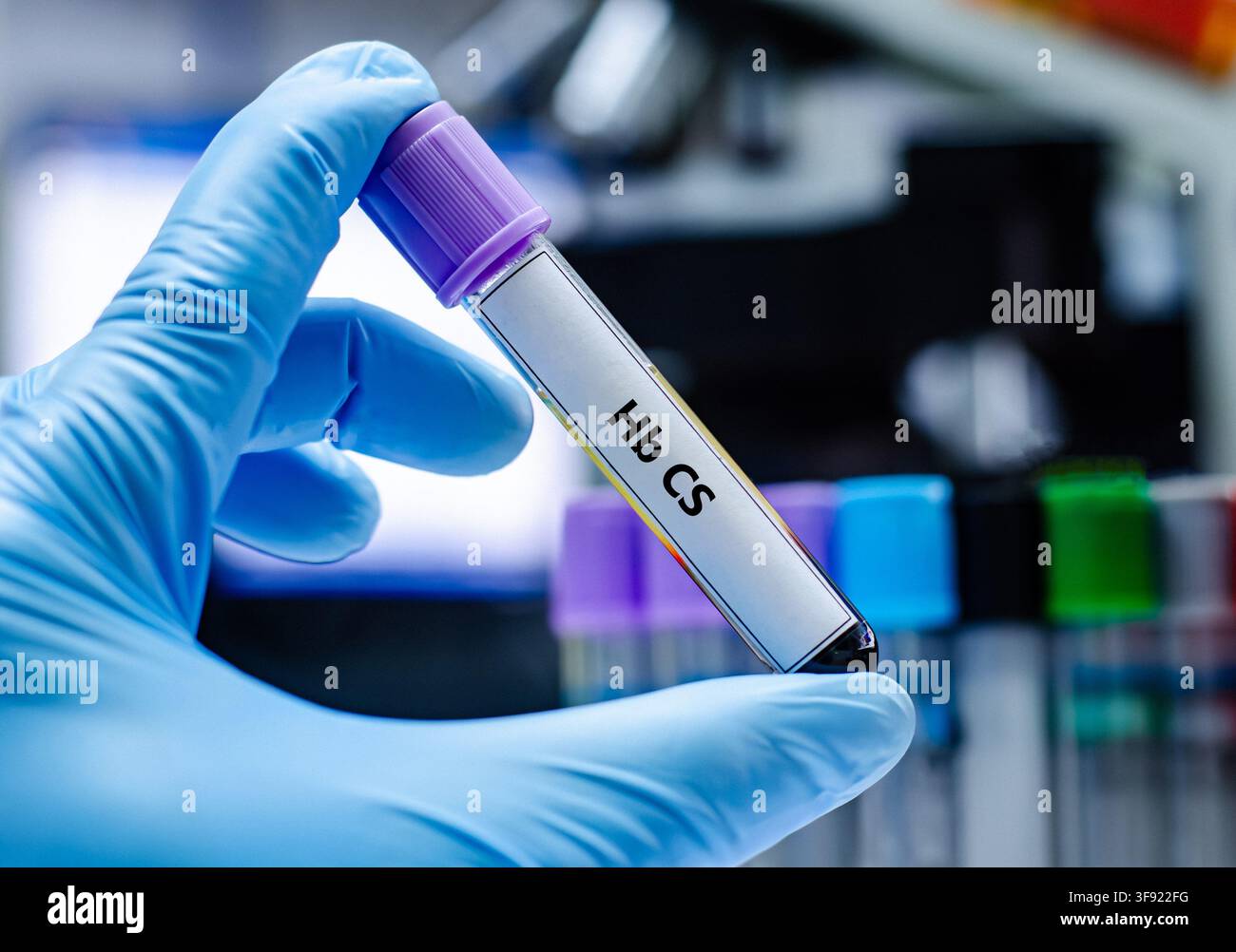 Blutprobenröhrchen für die Hb CS-Testanalyse. Stockfoto