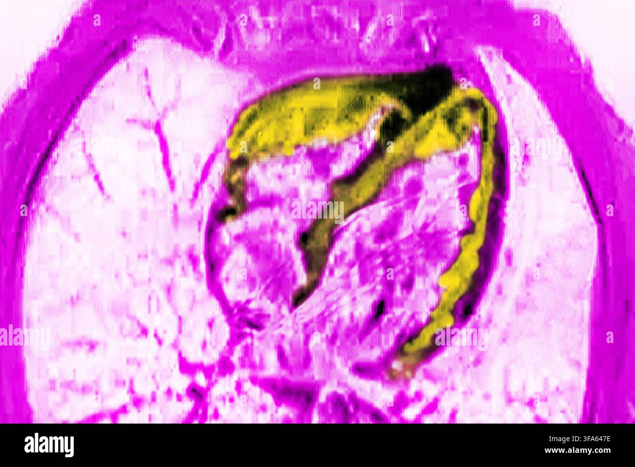 Myokarditis ist eine Entzündung der Herzwand, die gewöhnlich durch Viren verursacht wird und zu Herzversagen, unregelmäßigem Herzschlag und plötzlichem Tod führen kann. Stockfoto