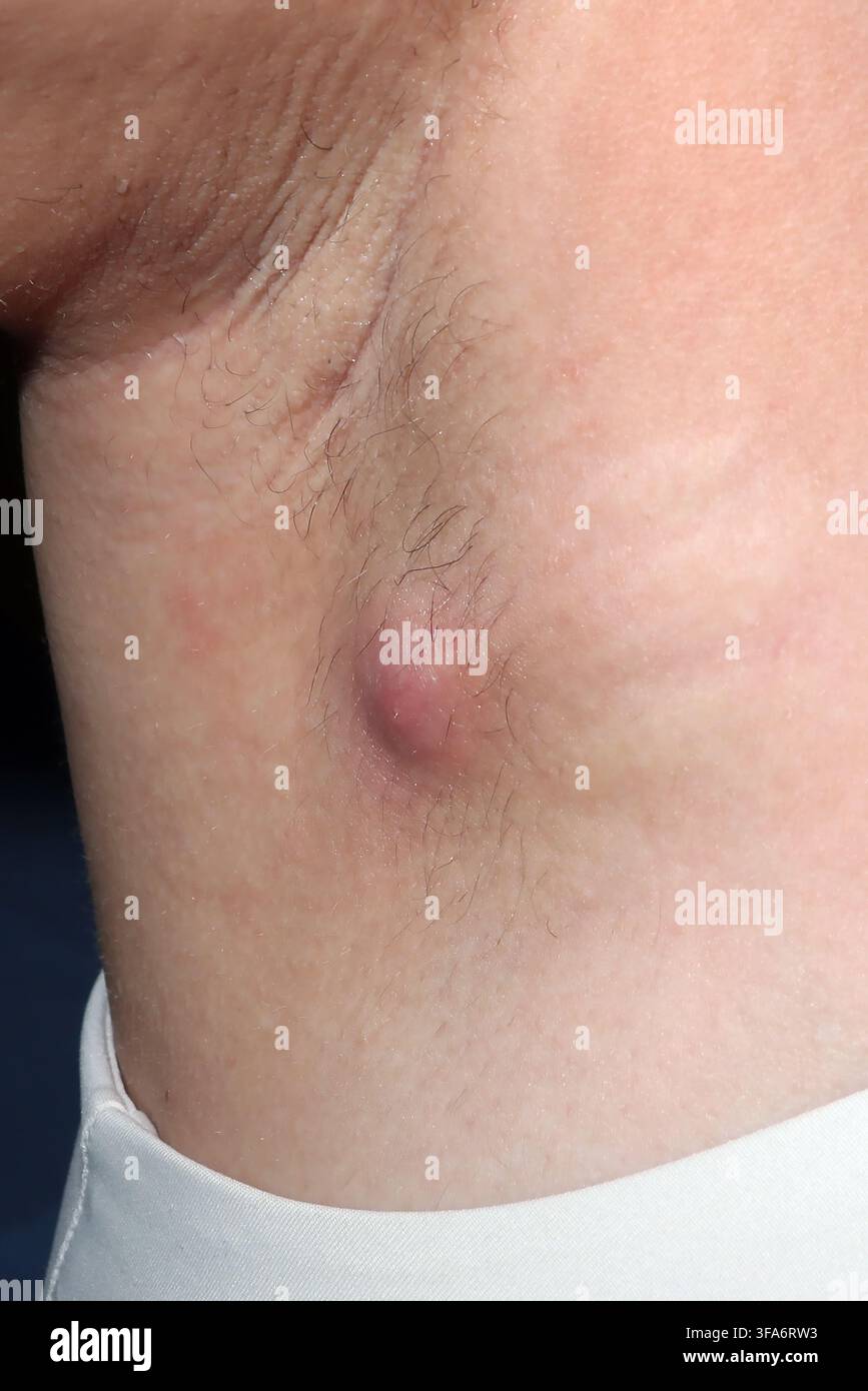 Achselhautabszess bei einer 26-jährigen Frau. Stockfoto