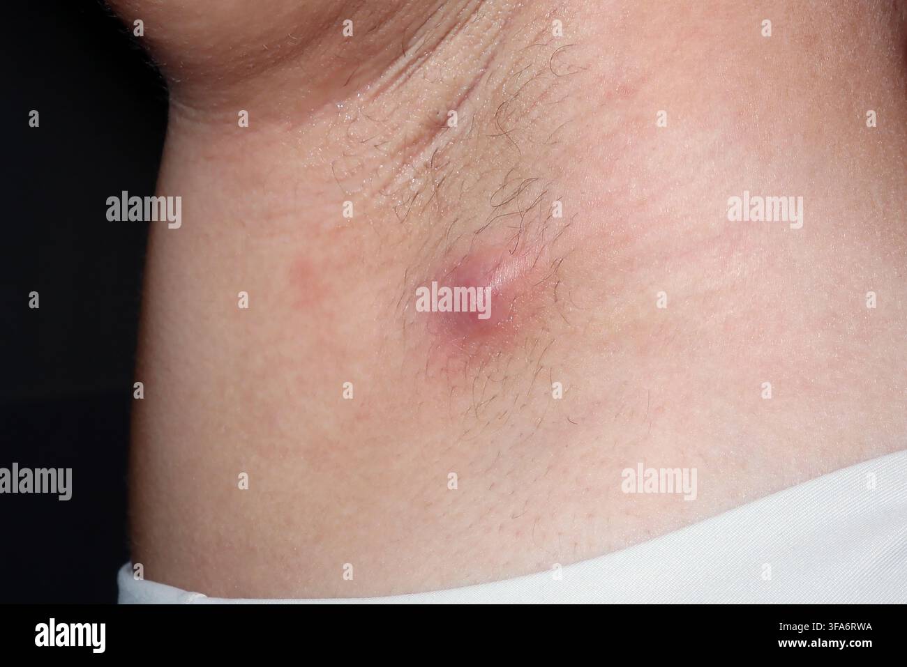 Achselhautabszess bei einer 26-jährigen Frau. Stockfoto
