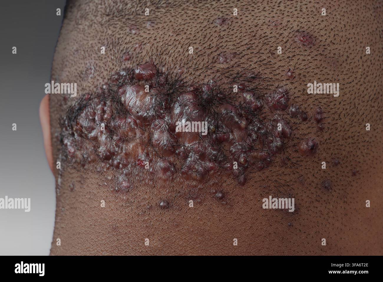 Keloid-Akne im Nackenbereich bei einem 21-jährigen Mann. Stockfoto