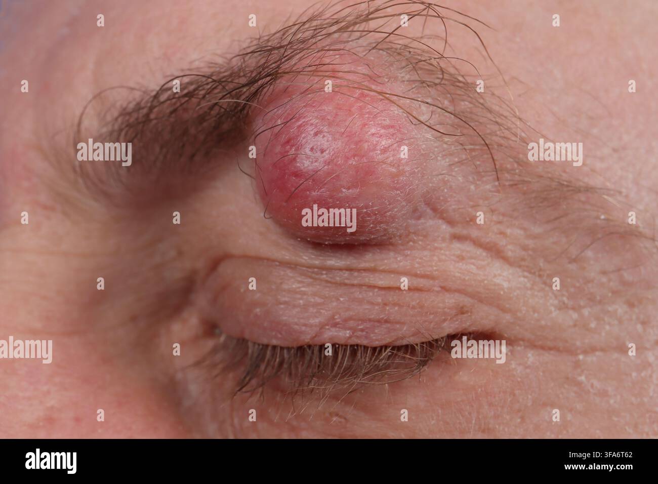Augenbrauenzyste bei einem 54-jährigen Mann. Stockfoto