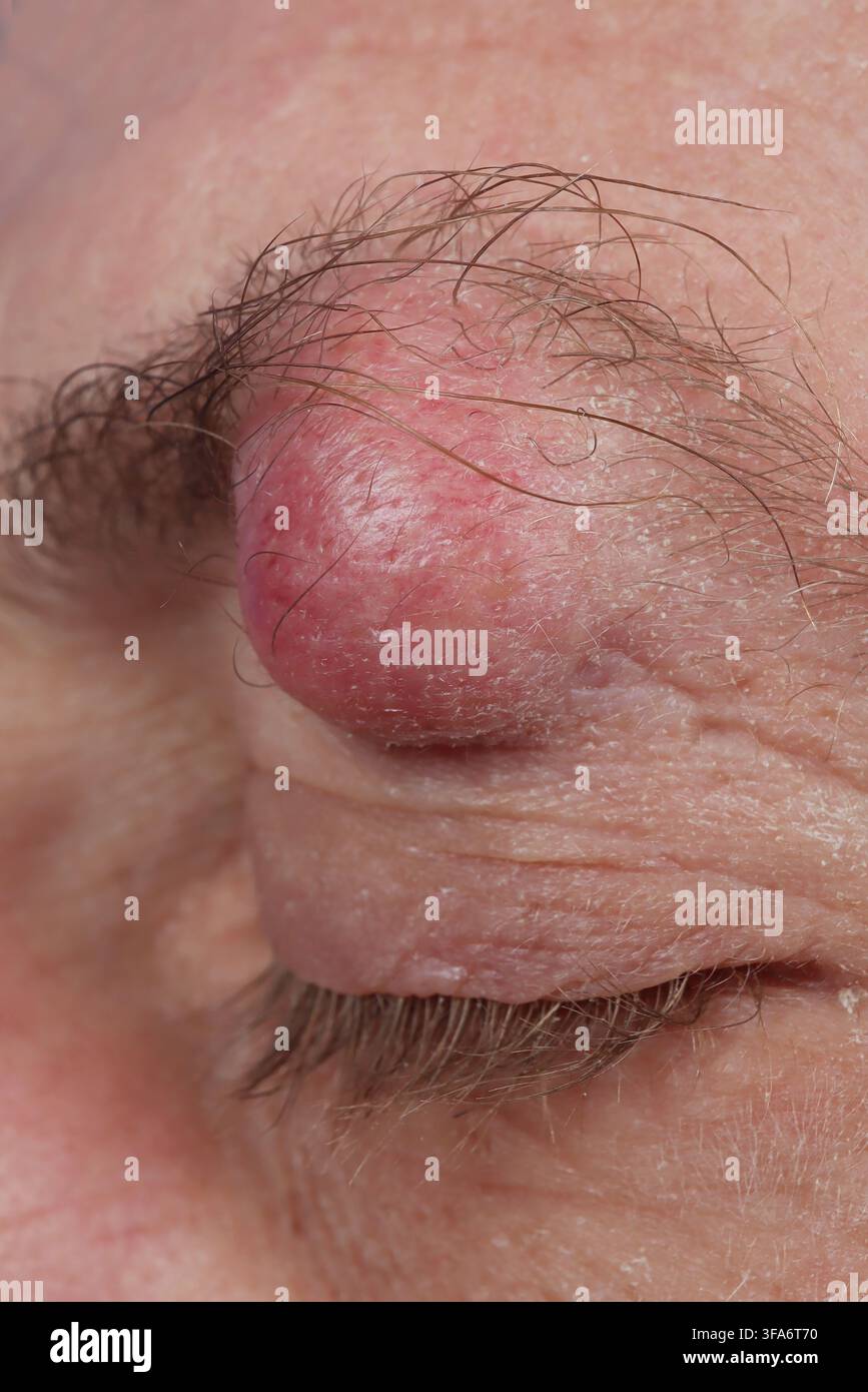 Augenbrauenzyste bei einem 54-jährigen Mann. Stockfoto