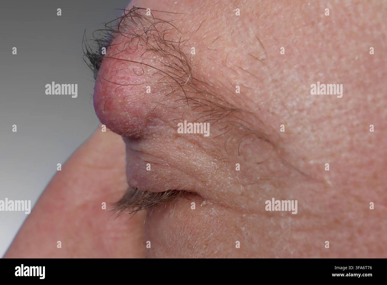 Augenbrauenzyste bei einem 54-jährigen Mann. Stockfoto