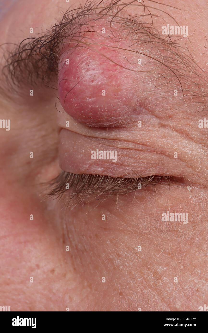 Augenbrauenzyste bei einem 54-jährigen Mann. Stockfoto