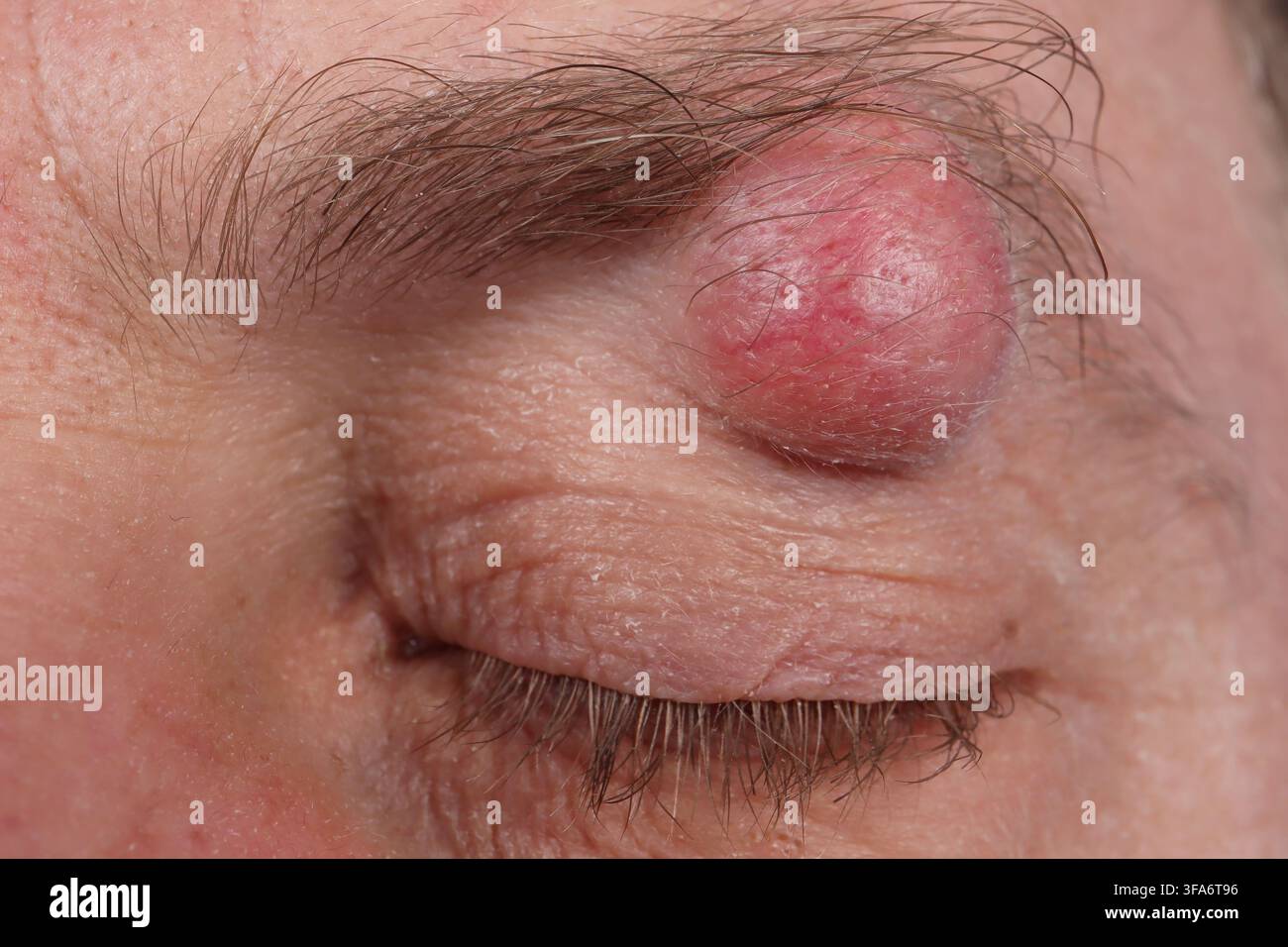 Augenbrauenzyste bei einem 54-jährigen Mann. Stockfoto