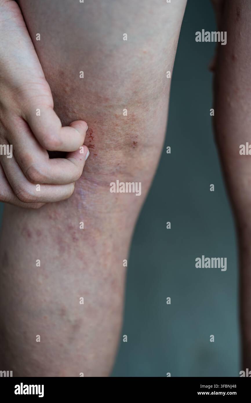 Person kratzt sich an juckenden Beinen bei atopischer Dermatitis. Nahaufnahme einer Hand auf roter gereizter Haut mit Ausschlag, Ekzem und Allergiesymptomen. Stockfoto