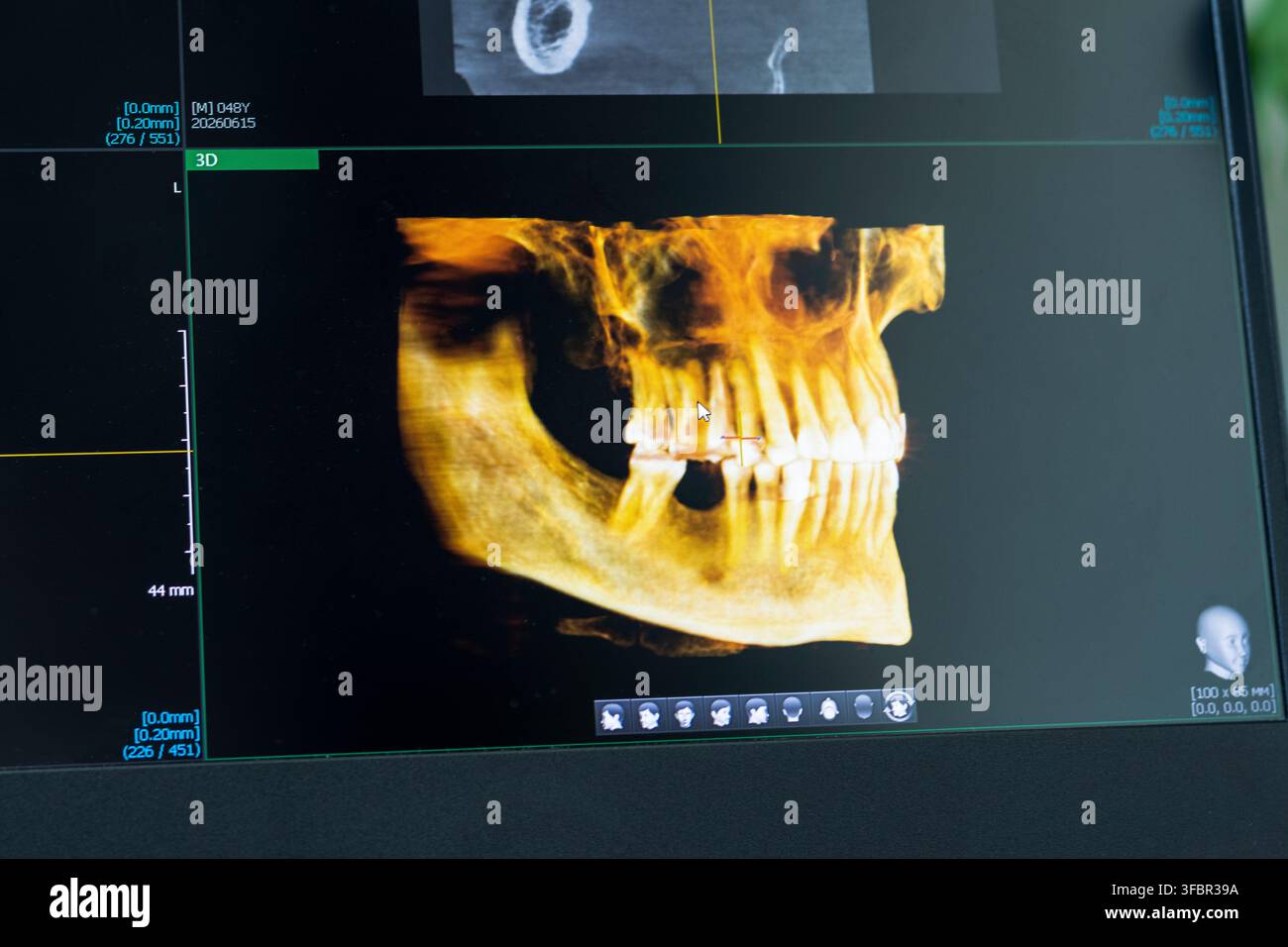 Computerbildschirm zeigt 3D-Farben-Volumen-Dental-Scan von Kiefer und Zahn Bögen Stockfoto
