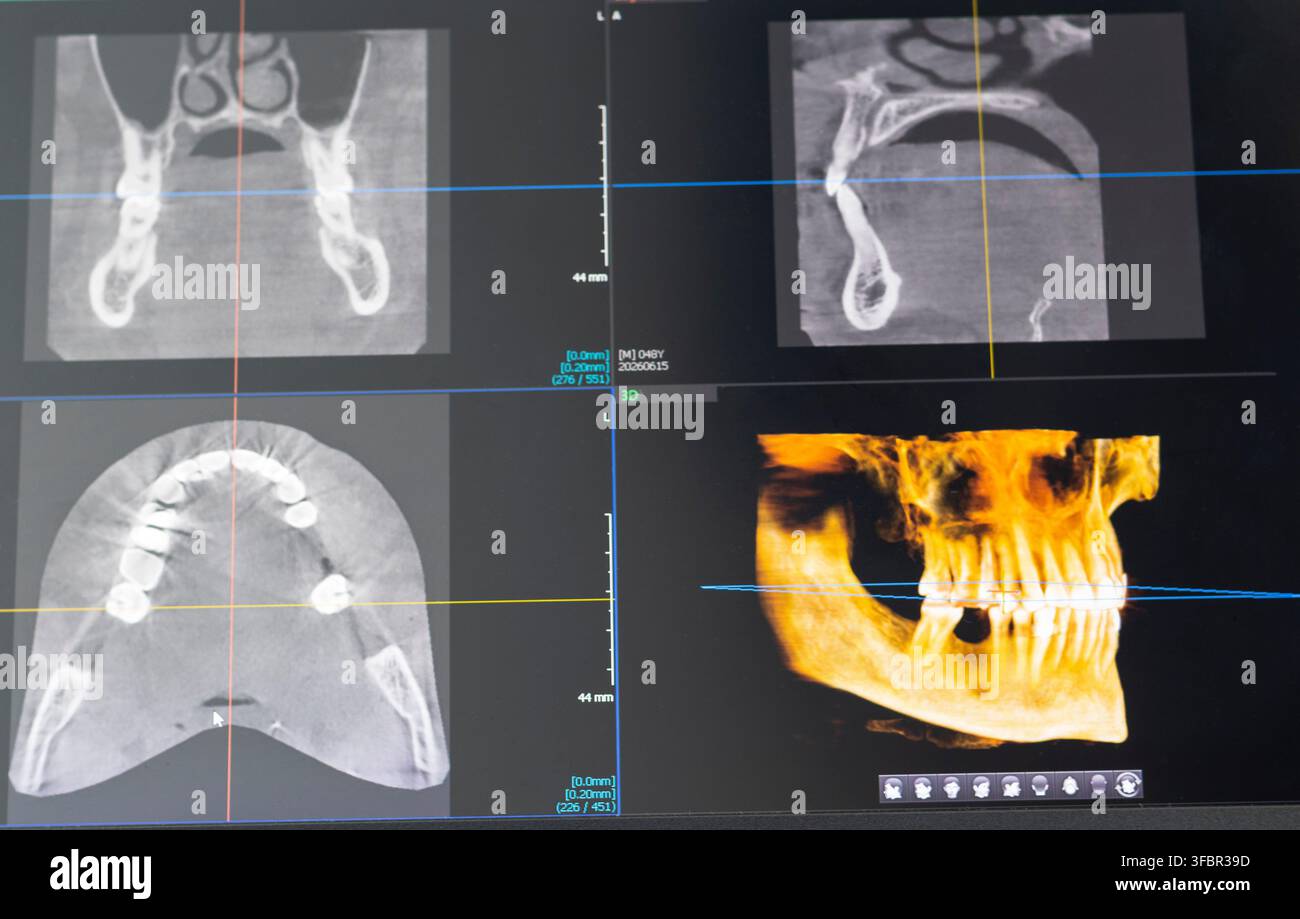 Dentales CBCT-Bildschnittsbild-Schnittstelle mit koronaren sagittalen axialen Ansichten und 3D-Kieferscan Stockfoto