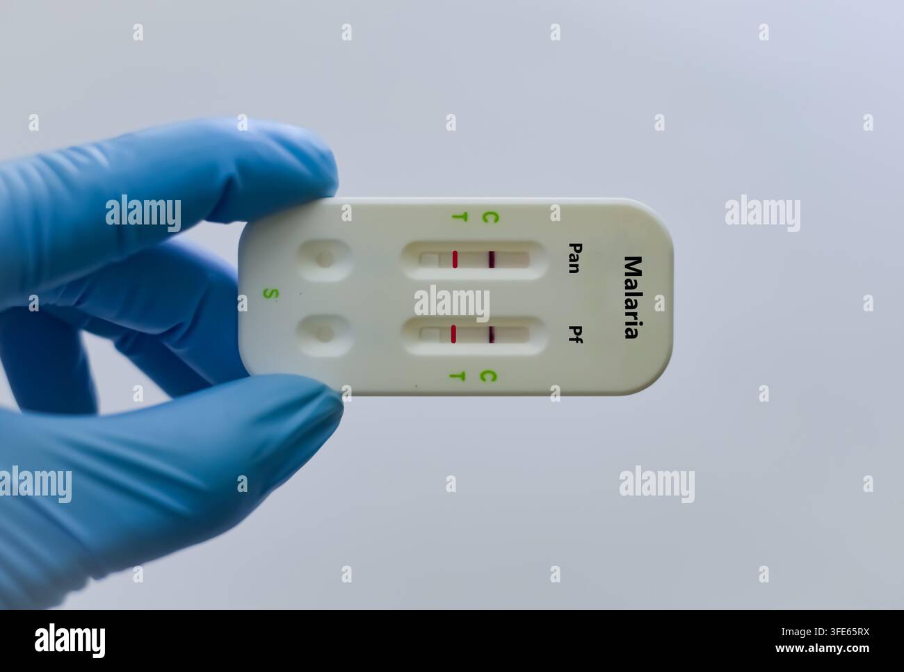 Blutprobe eines Patienten mit positivem Malariabefund Stockfoto