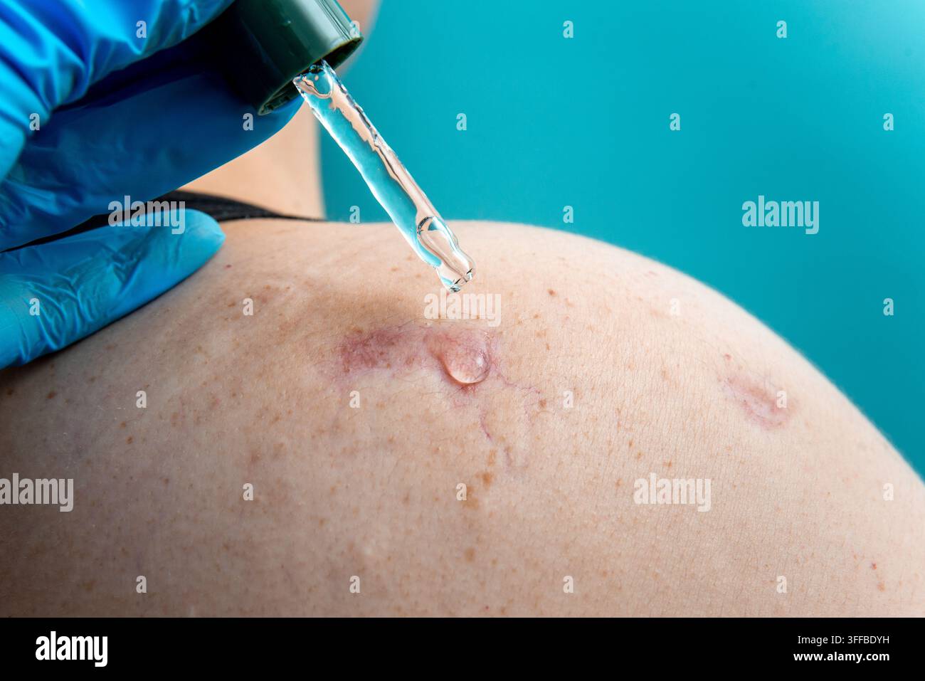 Ein Glas-Tropfer gibt klare Flüssigkeit auf rötliche Flecken auf blasser Schultermhaut ab. Stockfoto