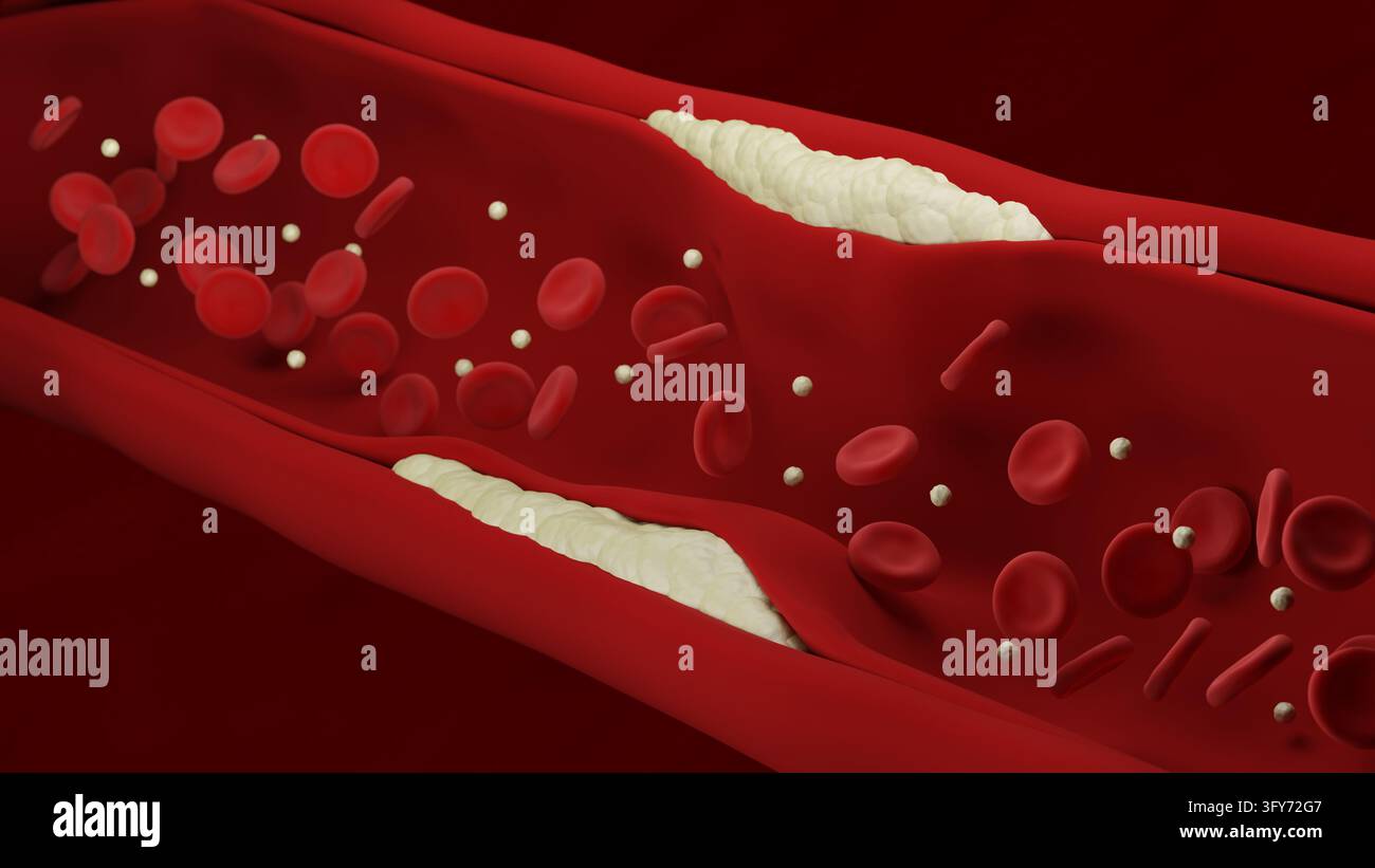 Arteriosklerose. Eine atherosklerotische Plakette wächst. 3D-Illustration. Stockfoto