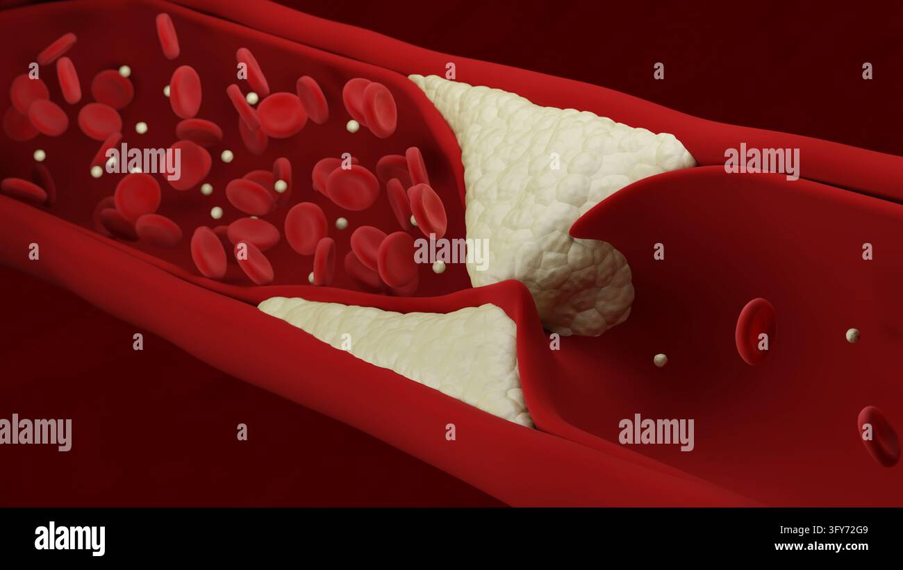 Arteriosklerose. Ruptur einer Atherosklerose-Plaque. Blutgerinnsel. 3D-Illustration. Stockfoto