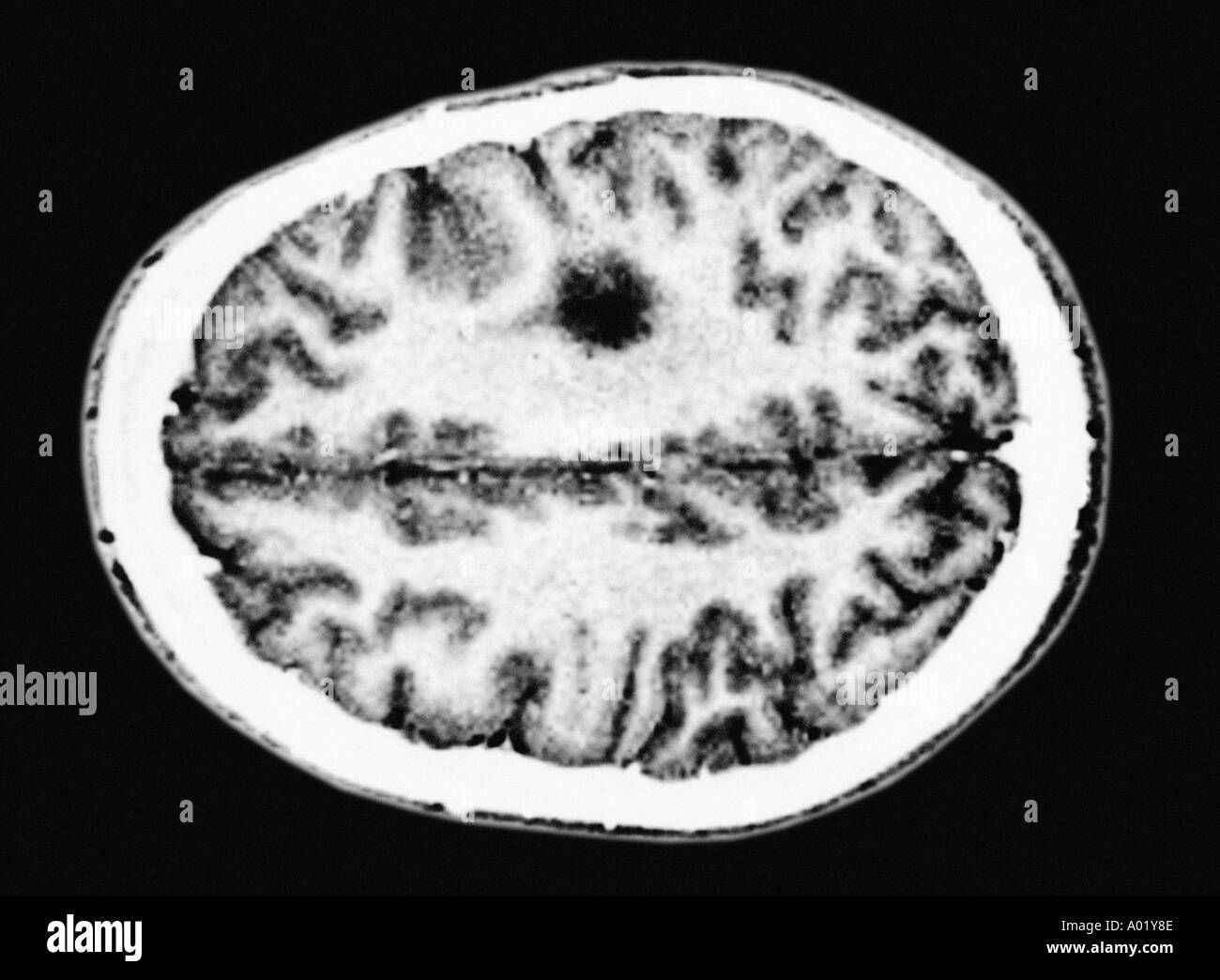 MRT des Gehirns zeigen Gliom tumor Stockfoto