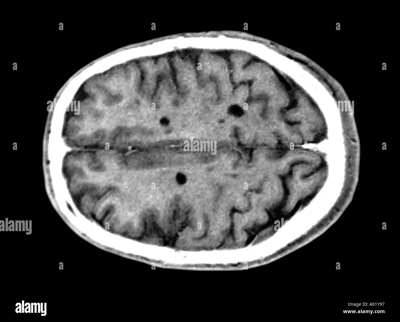 MRT des Gehirns zeigen Plaques der multiplen Sklerose Stockfoto