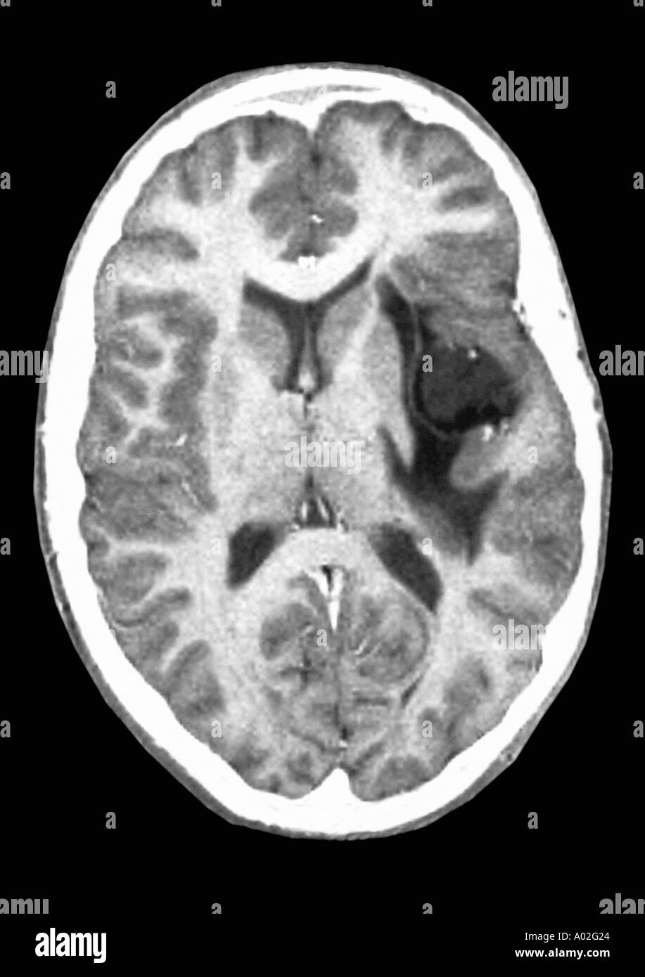 Cat-Scan zeigt Gliom Gehirntumor Stockfoto
