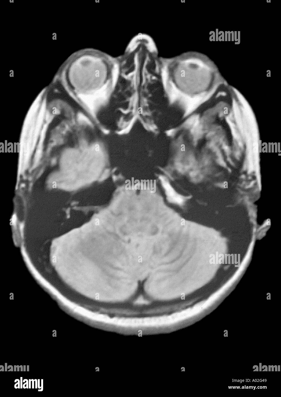 MRI Gehirn-Scan einer Frau Stockfoto