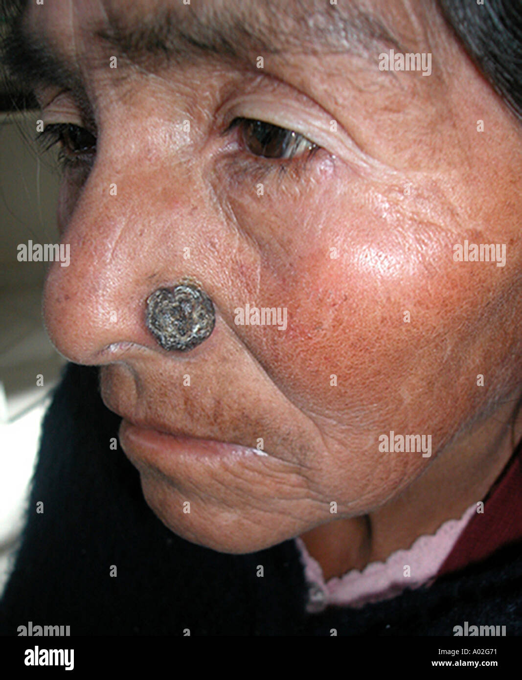 Basalzell-Karzinom des Gesichts Stockfoto