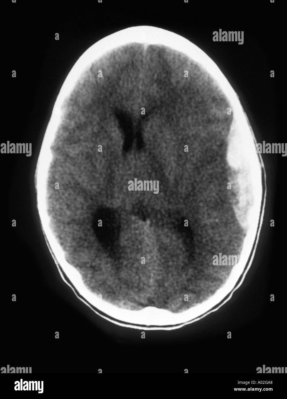 CT-Scan des Gehirns 10 jährige junge epidurales Hämatom von Trauma.  Die Ventrikel sind komprimiert und seitlich versetzt Stockfoto