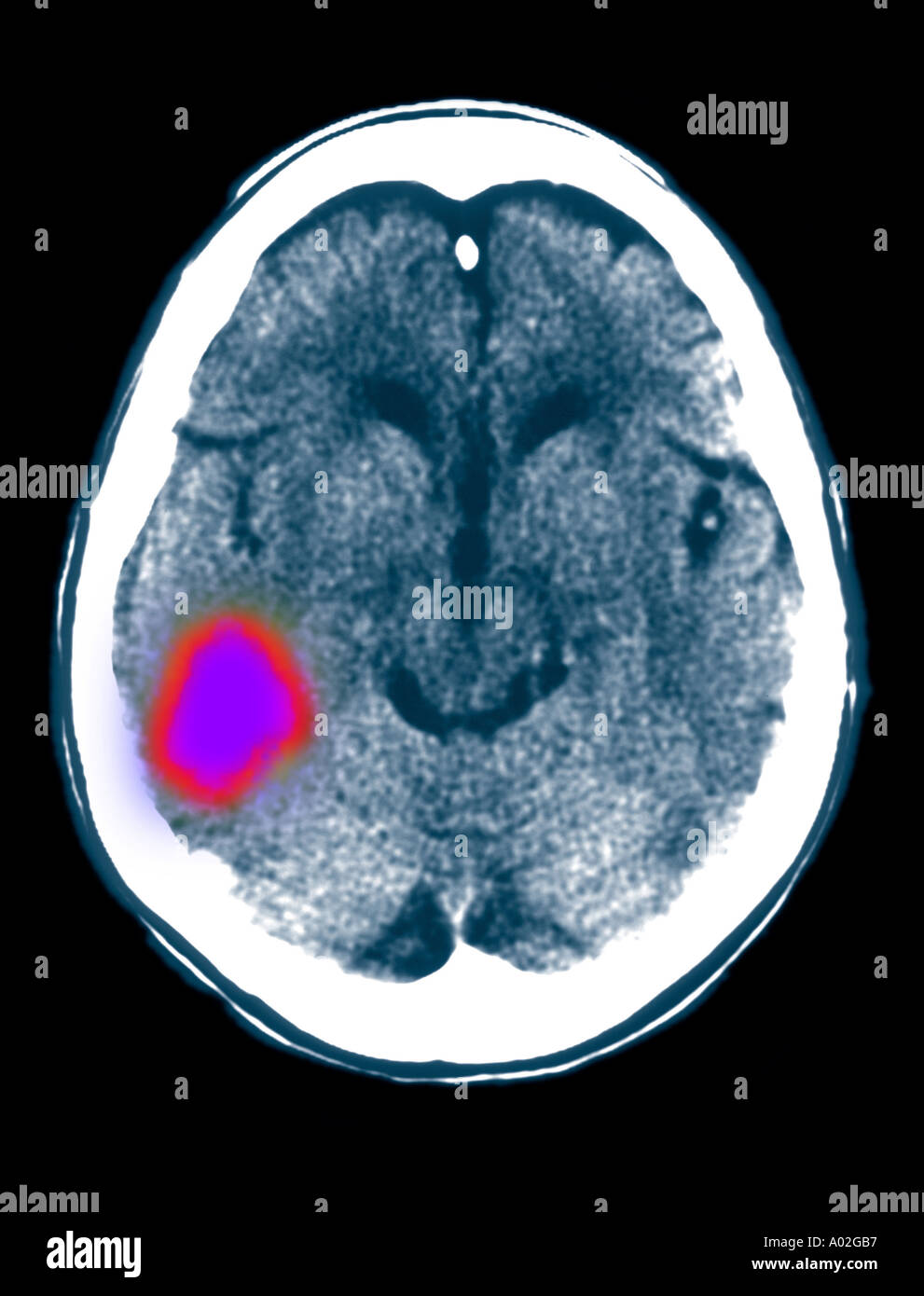 66 Jahre alten weiblichen CT-Scan des Gehirns zeigt Linken posterioren temporalen Hirnblutung Stockfoto