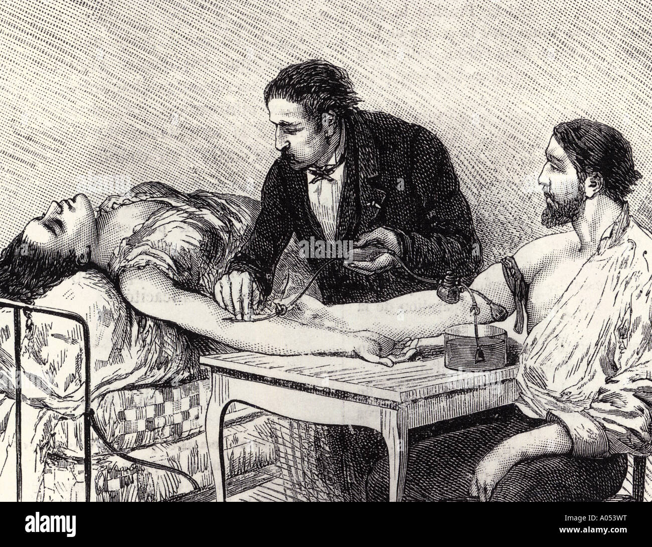 Bluttransfusion Gravur eine direkte, Peron, Person Transfusion 1882 - siehe Beschreibung unten Stockfoto