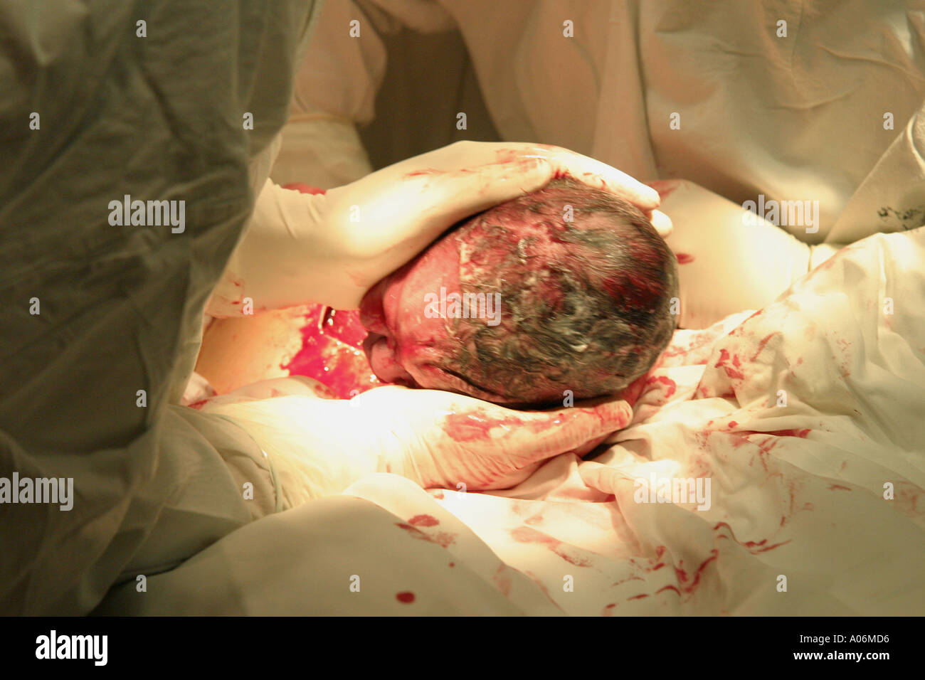 Die Geburt eines Babys per Kaiserschnitt, Kaiserschnitt, Kaiserschnitt