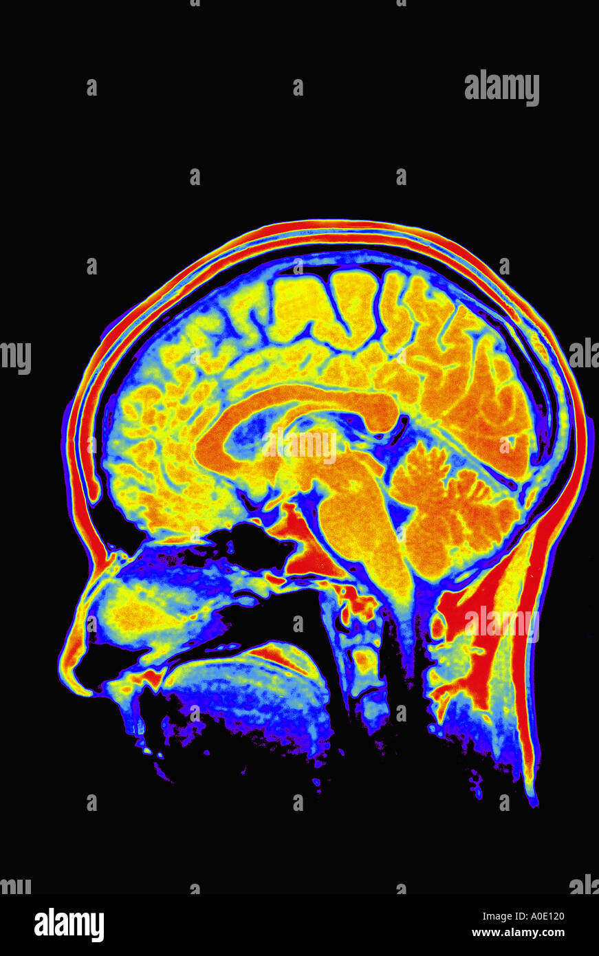 Gehirn-MRT-Untersuchung Stockfoto